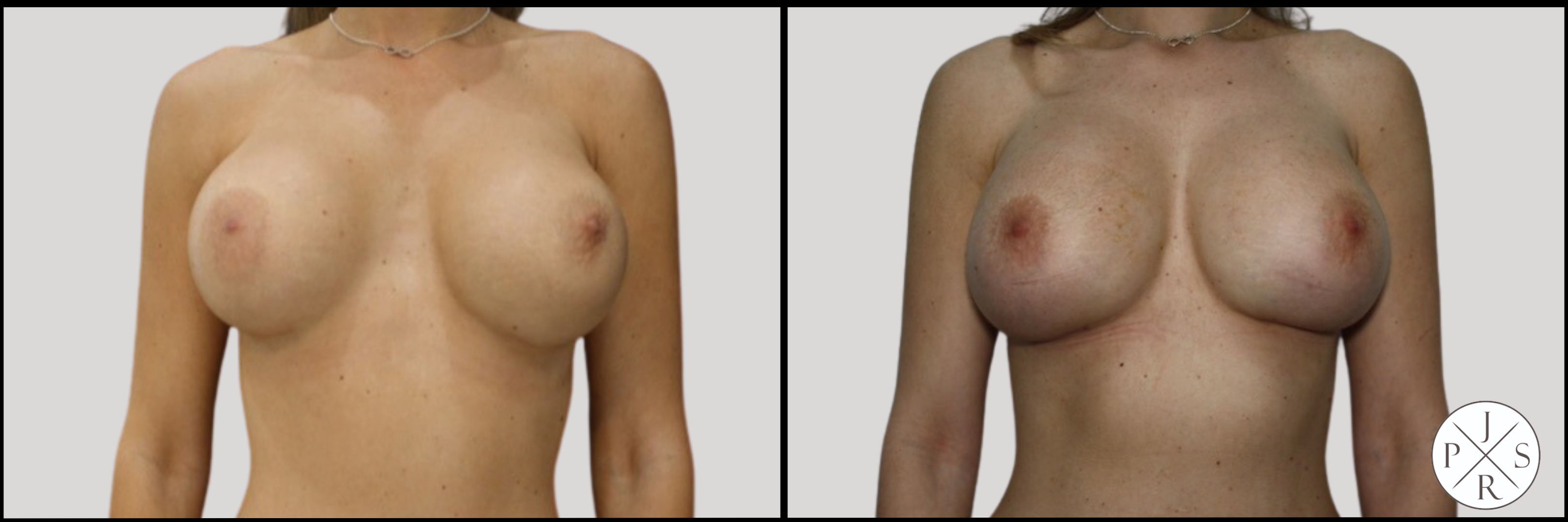 Breast Revision Before & After Image